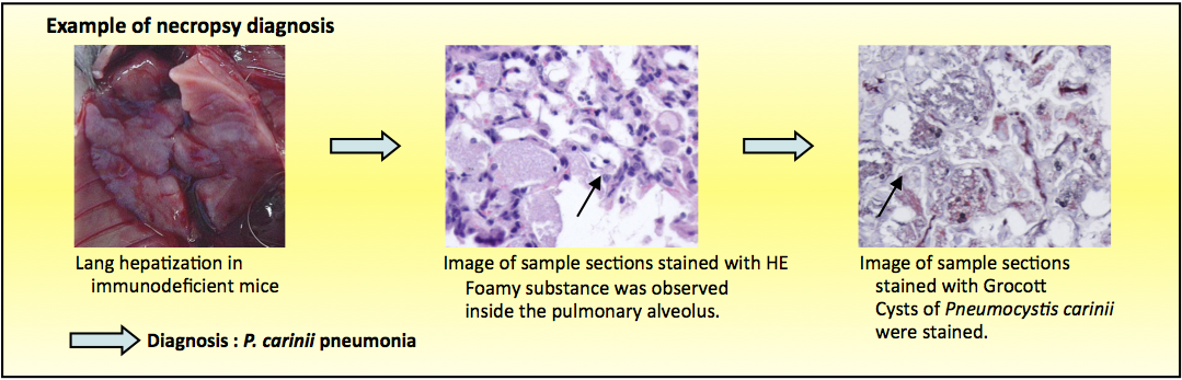 Example of autopsy diagnosis  Diagnosis: P. carinii pneumonia