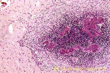 右: <i>S. aureus</i> 自然感染ヌードマウスの心臓組織 (H&E染色像) : 化膿性心筋炎