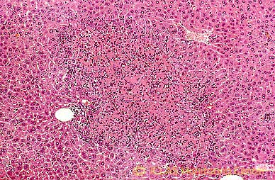 左: <i>H. hepaticus</i> 実験感染SCIDマウスの肝組織 (H&E染色像) : 巣状壊死性肝炎