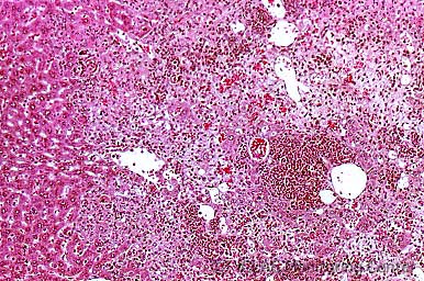 MHV感染マウスの肝組織 (H&E染色像) : MHV肝炎 (巣状壊死性肝炎)