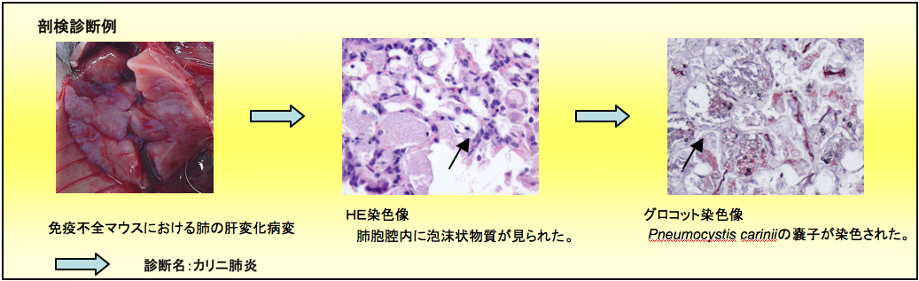 剖検診断例 診断名：: カリニ肺炎
